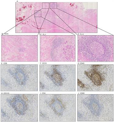 Maturity and density of tertiary lymphoid structures associate with tumor metastasis and chemotherapy response